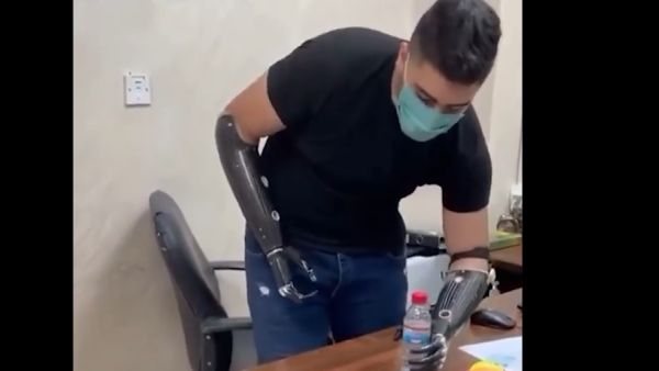 "فتى الزرقاء" يحصل على يدين اصطناعيتين ويبدأ العودة للحياة الطبيعية (فيديو)