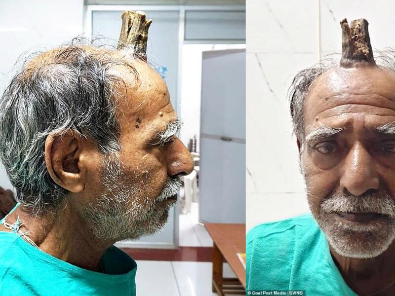 Shyam Lal Yadav, 74, from India, had to have a four-inch horn removed from the top of his head. (Daily Mail)