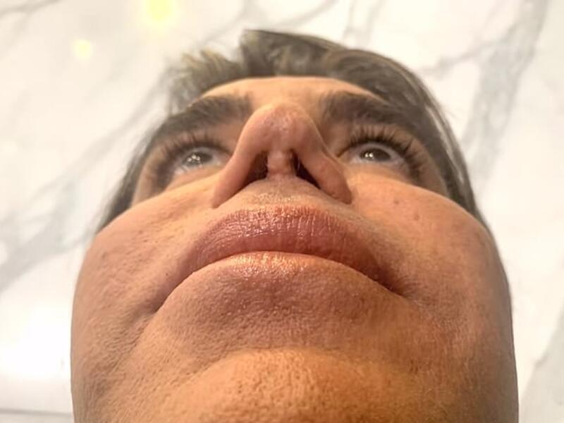 Sammy is meeting with the Botched doctors to see if they will be able to give him his old nose back. 'I would love to breathe better and for my nose to look better,' he says (dailymail)  