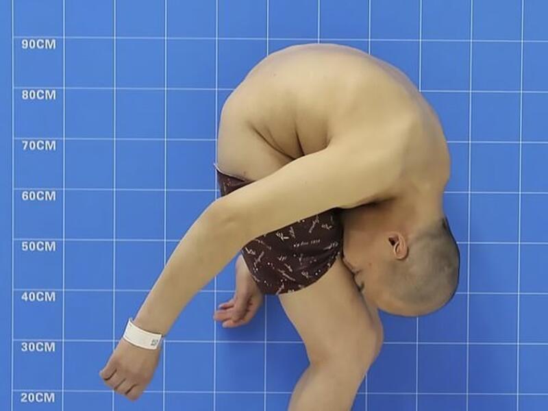 Mr Hua had surgery at Shenzhen University General Hospital . (Daily Mail)