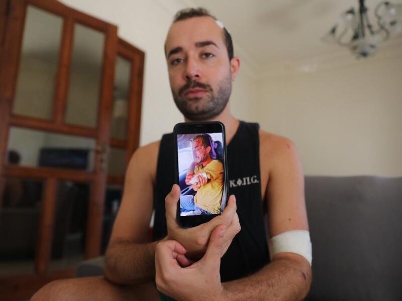 Lebanese makeup artist Sharbel Hasbany, 29, who was injured in the massive Beirut port explosion, displays an image on his phone of himself after the blast, during an interview at home in the Sin el-Fil neighbourhood of the Lebanese capital, on August 16, 2020. ANWAR AMRO / AFP