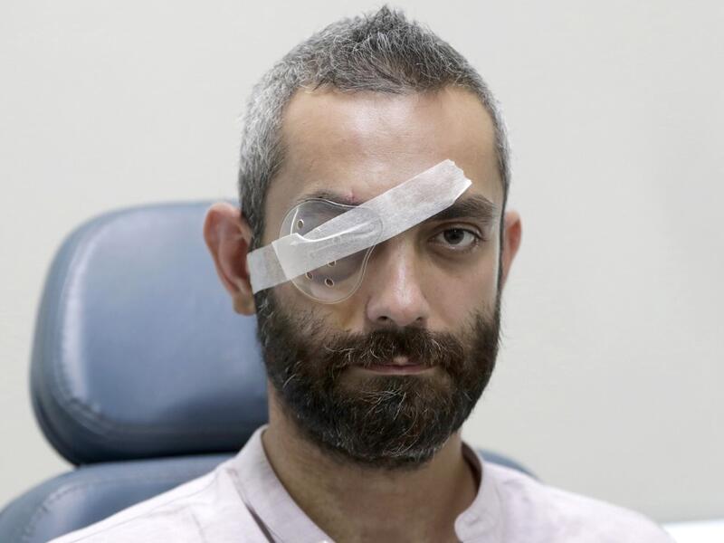 Maroun Dagher, 34-year-old web developer who lost sight in one eye due to the August 4 cataclysmic explosion, poses for a picture during his third checkup at the Eye and Ear hospital, north of the Lebanese capital Beirut, on August 17, 2020. ANWAR AMRO / AFP