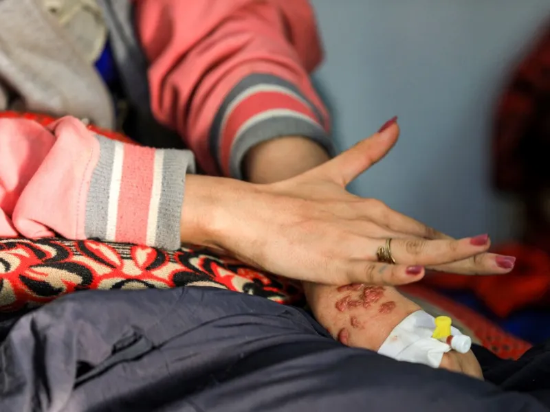 Al-Anoud Hussain Sheryan, a 19-year-old girl disfigured in an acid attack by her abusive husband, holds her hands together as she sits at a hospital where she is undergoing treatment in Yemen's capital Sanaa on January 28, 2021. Married at the age of 12, rejected at 16, and then disfigured in an acid attack, Sheryan's fate is a shocking illustration of abuse in a society beset by war and poverty. Now aged 19, the young Yemeni woman agreed to relate her ordeal at the hands of her abusive husband -- rare test
