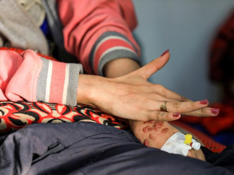 Al-Anoud Hussain Sheryan, a 19-year-old girl disfigured in an acid attack by her abusive husband, holds her hands together as she sits at a hospital where she is undergoing treatment in Yemen's capital Sanaa on January 28, 2021. Married at the age of 12, rejected at 16, and then disfigured in an acid attack, Sheryan's fate is a shocking illustration of abuse in a society beset by war and poverty. Now aged 19, the young Yemeni woman agreed to relate her ordeal at the hands of her abusive husband -- rare test
