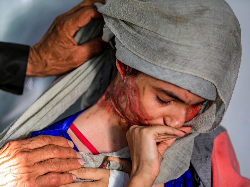 Al-Anoud Hussain Sheryan, a 19-year-old girl disfigured in an acid attack by her abusive husband, sits at a hospital where she is undergoing treatment in Yemen's capital Sanaa on January 28, 2021 as a woman unwraps her veil to show her injuries. Married at the age of 12, rejected at 16, and then disfigured in an acid attack, Sheryan's fate is a shocking illustration of abuse in a society beset by war and poverty. Now aged 19, the young Yemeni woman agreed to relate her ordeal at the hands of her abusive hus