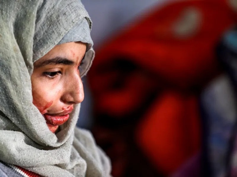 Al-Anoud Hussain Sheryan, a 19-year-old girl disfigured in an acid attack by her abusive husband, sits at a hospital where she is undergoing treatment in Yemen's capital Sanaa on January 28, 2021. Married at the age of 12, rejected at 16, and then disfigured in an acid attack, Sheryan's fate is a shocking illustration of abuse in a society beset by war and poverty. Now aged 19, the young Yemeni woman agreed to relate her ordeal at the hands of her abusive husband -- rare testimony in a country where domesti