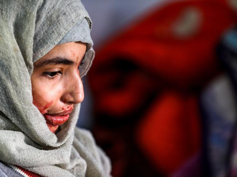 Al-Anoud Hussain Sheryan, a 19-year-old girl disfigured in an acid attack by her abusive husband, sits at a hospital where she is undergoing treatment in Yemen's capital Sanaa on January 28, 2021. Married at the age of 12, rejected at 16, and then disfigured in an acid attack, Sheryan's fate is a shocking illustration of abuse in a society beset by war and poverty. Now aged 19, the young Yemeni woman agreed to relate her ordeal at the hands of her abusive husband -- rare testimony in a country where domesti