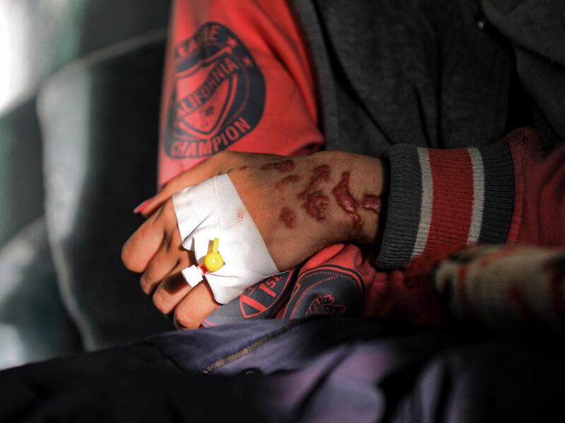 Al-Anoud Hussain Sheryan, a 19-year-old girl disfigured in an acid attack by her abusive husband, clasps her arm as she sits at a hospital where she is undergoing treatment in Yemen's capital Sanaa on January 28, 2021. Married at the age of 12, rejected at 16, and then disfigured in an acid attack, Sheryan's fate is a shocking illustration of abuse in a society beset by war and poverty. Now aged 19, the young Yemeni woman agreed to relate her ordeal at the hands of her abusive husband -- rare testimony in a
