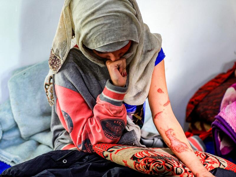 Al-Anoud Hussain Sheryan, a 19-year-old girl disfigured in an acid attack by her abusive husband, sits at a hospital where she is undergoing treatment in Yemen's capital Sanaa on January 28, 2021. Married at the age of 12, rejected at 16, and then disfigured in an acid attack, Sheryan's fate is a shocking illustration of abuse in a society beset by war and poverty. Now aged 19, the young Yemeni woman agreed to relate her ordeal at the hands of her abusive husband -- rare testimony in a country where domesti