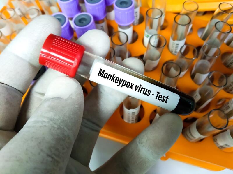 Mexico confirms 1st monkeypox case