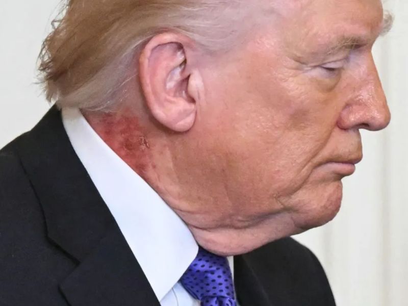 "بقعة حمراء" في رقبة ترامب