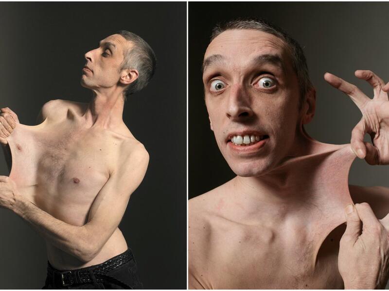 British man Garry Turner can stretch the skin of his stomach to 6.25 inches due to a rare medical condition called Ehlers-Danlos Syndrome. (Twitter)