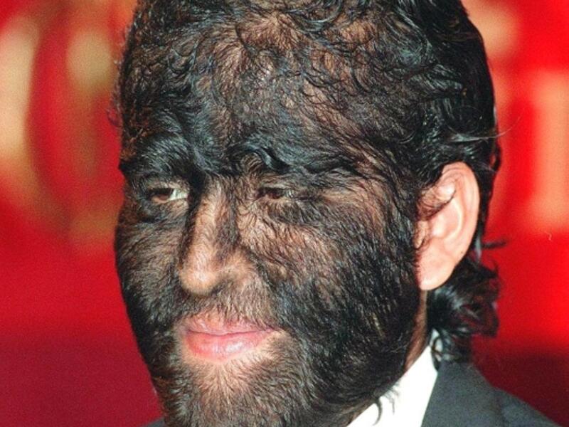 Fajardo Aceves Jesus Manuel, from Mexico, know as the “wolfman” in the Guinness World of Records. Jesus Manuel, 24, whose hairy condition is a result of hiper tricosis, a disease causing an overabundance of hair, says he inherited the condition from his great-grandmother. (AFP/ File Photo)