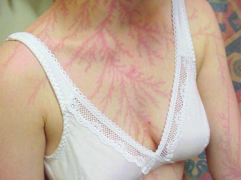 This woman was left with a fern-shaped erythema known as a 'Lichtenberg figure', believed to be the result of a lightning strike on the skin (Twitter)