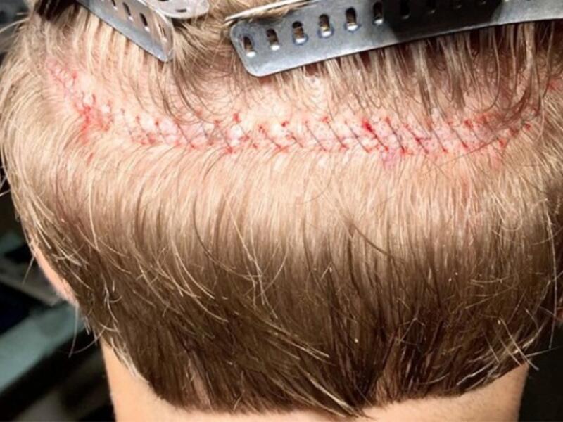 hair transplant
