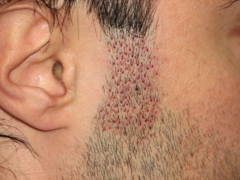 hair transplant sideburns