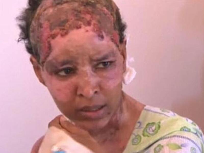 Another leaked relic of the regime: Burnt, blistered and left to rot in the plush Gaddafi house, Ethiopian nanny. She escaped Libya
& Gaddafi hell this weekend, offered sanctuary in Malta after heart-rending ordeal 'at the Gaddafi's'. Nanny to 
Hannibal's tribe, she was abused with scolding hot water for not complying with wife Aline's demands.
