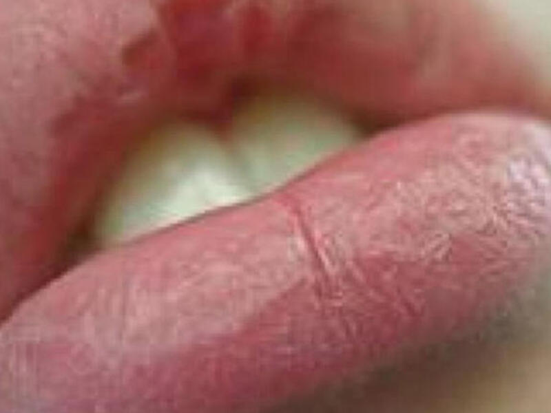 Fal'ha split lip