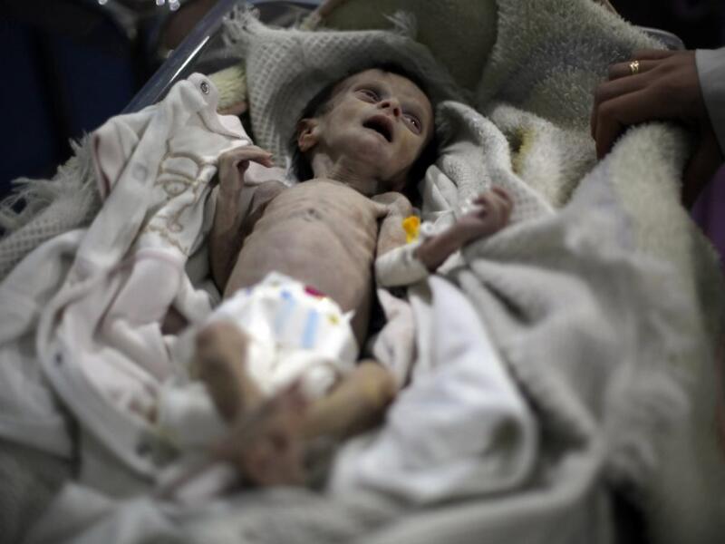 Sahar Difda, a one-year-old Syrian baby suffering from severe malnutrition who died in besieged Eastern Ghouta on Saturday (Amer Almohibany/AFP)
