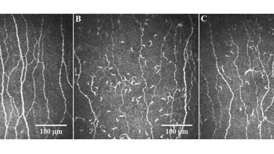 WCM-Q Researchers Use Pioneering Eye Exam To Identify Nerve Damage In Long Covid Patients