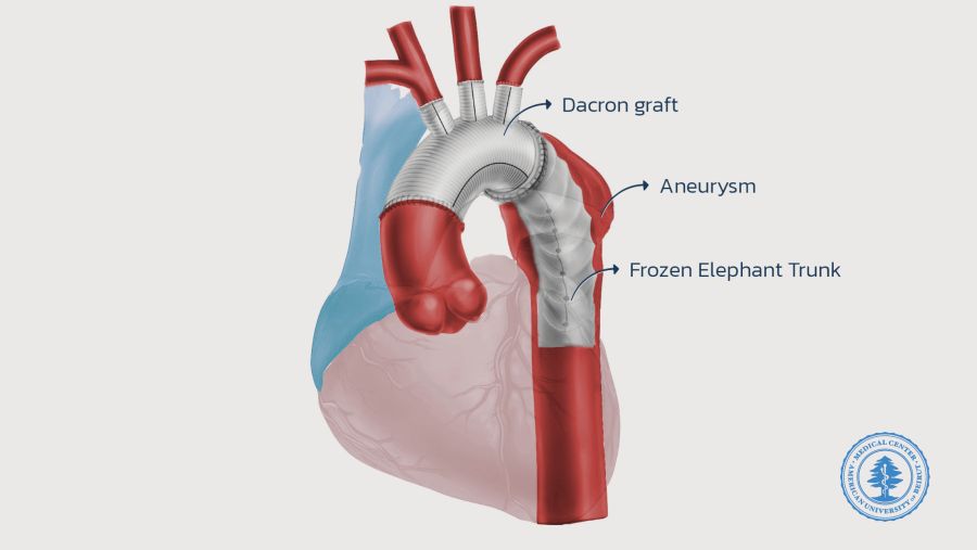 Breakthrough in Cardiac Surgery: AUBMC Performs the First Successful Frozen Elephant Trunk Surgery in Lebanon