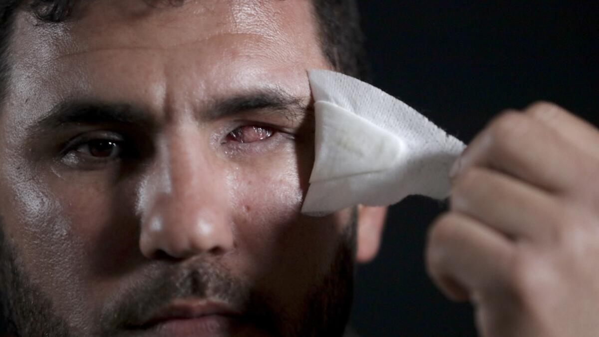 Sami Marsan, who lost his left eye in the ongoing conflict with Israel, poses during a photo session in Bureij refugee camp in central Gaza, on February 4 , 2020. Along the border of the Gaza Strip, the Israeli army uses snipers who, according to instructions, open fire only when the soldiers are at risk from intensifying violence from Palestinian rioters. Some were taking part in clashes, others simply in the wrong place at the wrong time. All were left scarred and their lives wrecked, even though in Pales