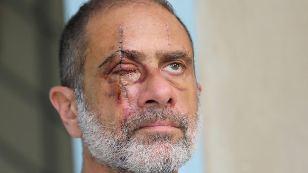 Rony Mecattaf, 59-year-old psychotherapist who lost his right eye in the August 4 cataclysmic explosion, poses for a picture at his psychotherapy clinic in Beirut's neighbourhood of Ashrafieh on August 15, 2020. ANWAR AMRO / AFP