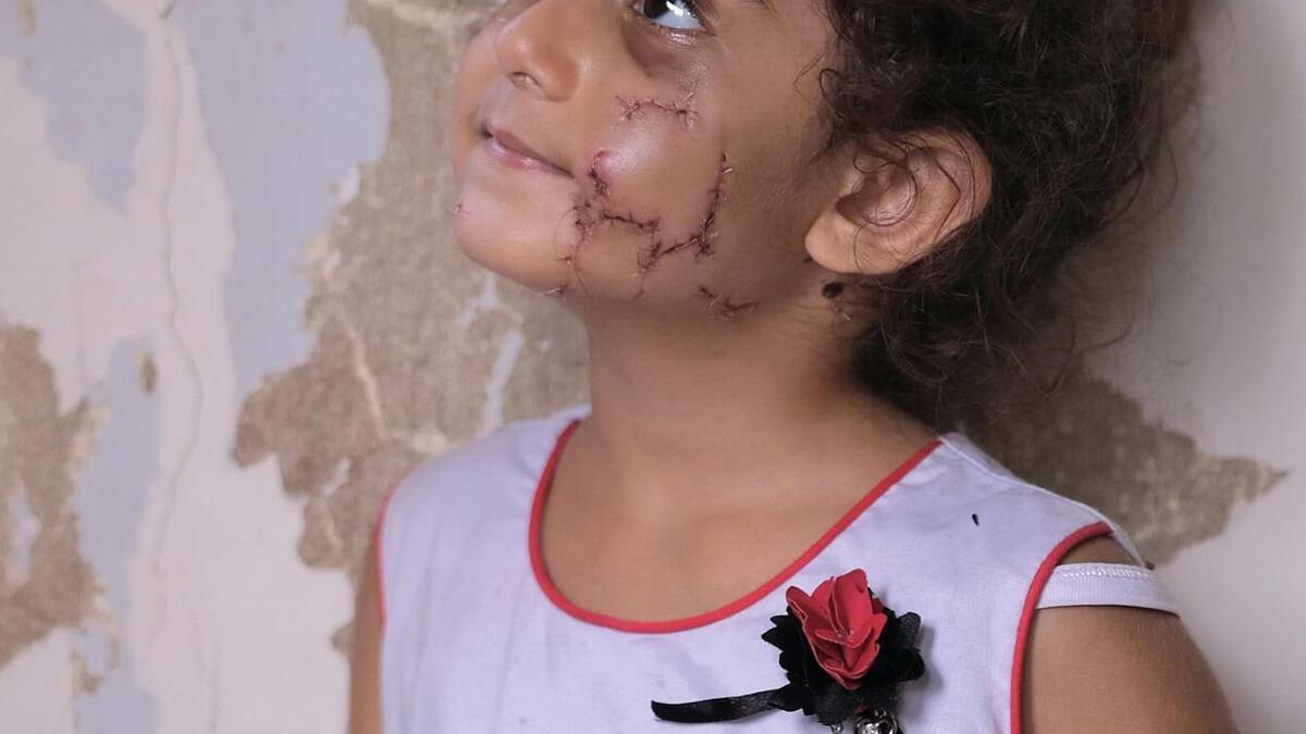 Yara, a 3-year-old girl, who was injured in the massive Beirut port explosion. Twitter