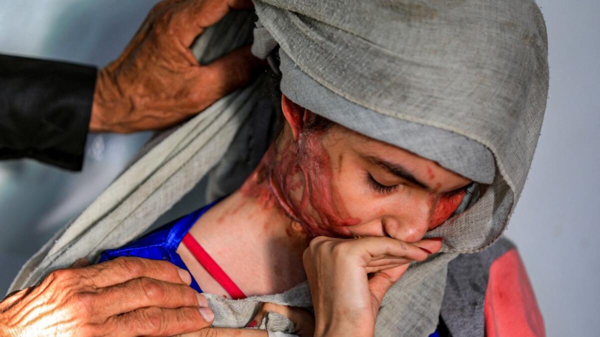 Al-Anoud Hussain Sheryan, a 19-year-old girl disfigured in an acid attack by her abusive husband, sits at a hospital where she is undergoing treatment in Yemen's capital Sanaa on January 28, 2021 as a woman unwraps her veil to show her injuries. Married at the age of 12, rejected at 16, and then disfigured in an acid attack, Sheryan's fate is a shocking illustration of abuse in a society beset by war and poverty. Now aged 19, the young Yemeni woman agreed to relate her ordeal at the hands of her abusive hus