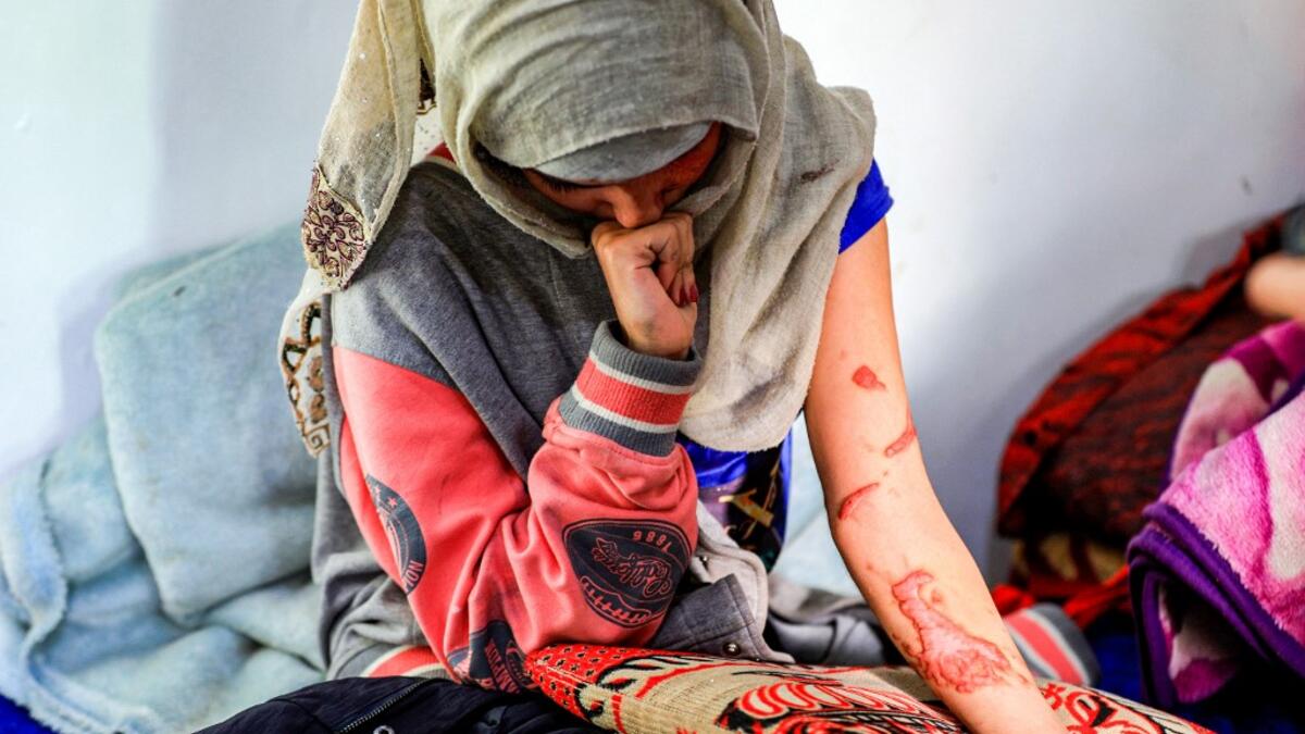 Al-Anoud Hussain Sheryan, a 19-year-old girl disfigured in an acid attack by her abusive husband, sits at a hospital where she is undergoing treatment in Yemen's capital Sanaa on January 28, 2021. Married at the age of 12, rejected at 16, and then disfigured in an acid attack, Sheryan's fate is a shocking illustration of abuse in a society beset by war and poverty. Now aged 19, the young Yemeni woman agreed to relate her ordeal at the hands of her abusive husband -- rare testimony in a country where domesti