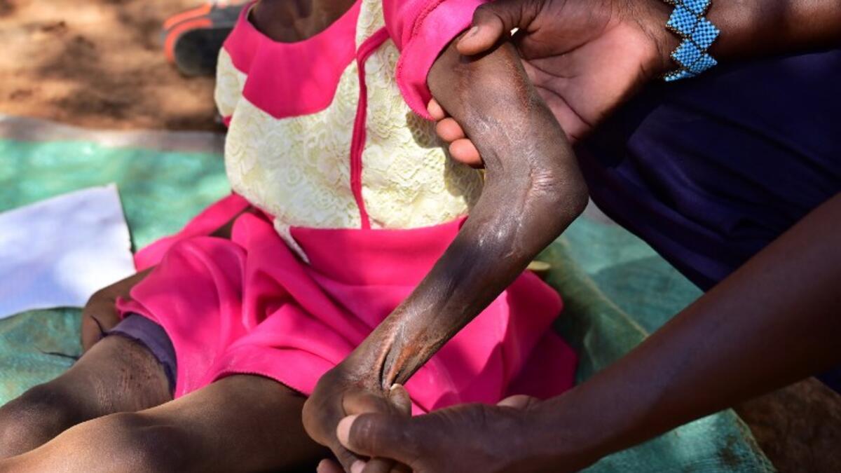 Chepchirchir Kiplagat (L), a 8-year-old child who partially lost the use of her body after a snakebit is held by her father Jackson Chepkui outside their home in the village of Embosos, in the Baringo county on February 22, 2019. 
TONY KARUMBA / AFP