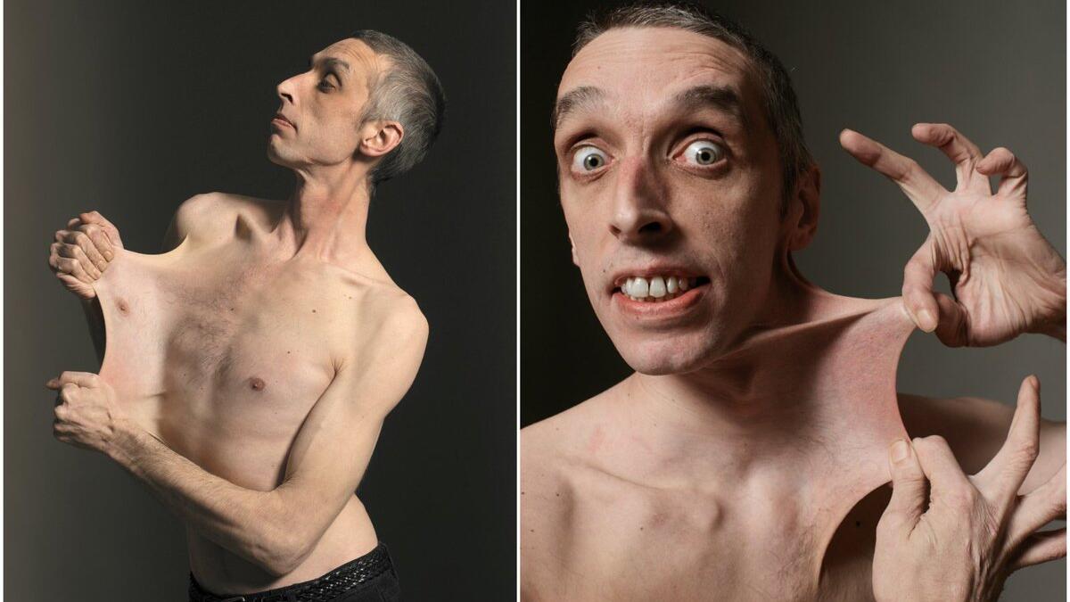 British man Garry Turner can stretch the skin of his stomach to 6.25 inches due to a rare medical condition called Ehlers-Danlos Syndrome. (Twitter)