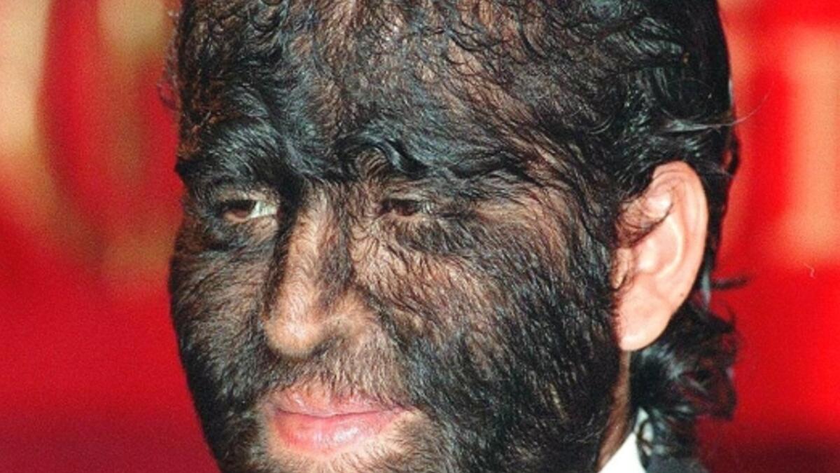 Fajardo Aceves Jesus Manuel, from Mexico, know as the “wolfman” in the Guinness World of Records. Jesus Manuel, 24, whose hairy condition is a result of hiper tricosis, a disease causing an overabundance of hair, says he inherited the condition from his great-grandmother. (AFP/ File Photo)