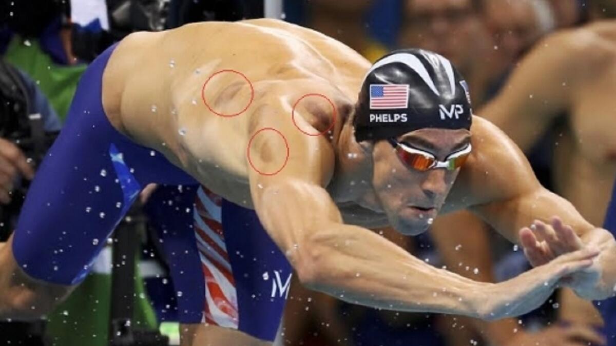 أثار السباح الأميركي مايكل فيلبس، المتوج في أولمبياد ريو دي جانيرو بذهبيته التاسعة عشرة في الألعاب الأولمبية، الفضول بنقاط دائرية داكنة على كتفيه. وظهرت أيضا على كتفي لاعب الجمباز أليكس ندور، لكنها ليست نتيجة تمارين، بل بسبب اللجوء الى علاج الطب البديل: الحجامة