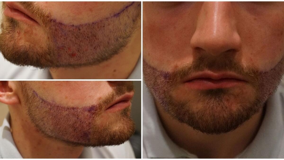 beard transplant