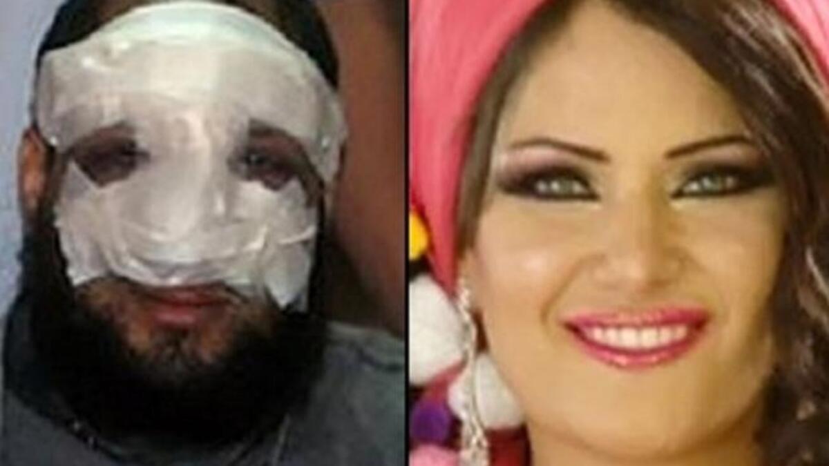 Anwar al-Balkimy post-nose-op and his rumored belly-dancer wife