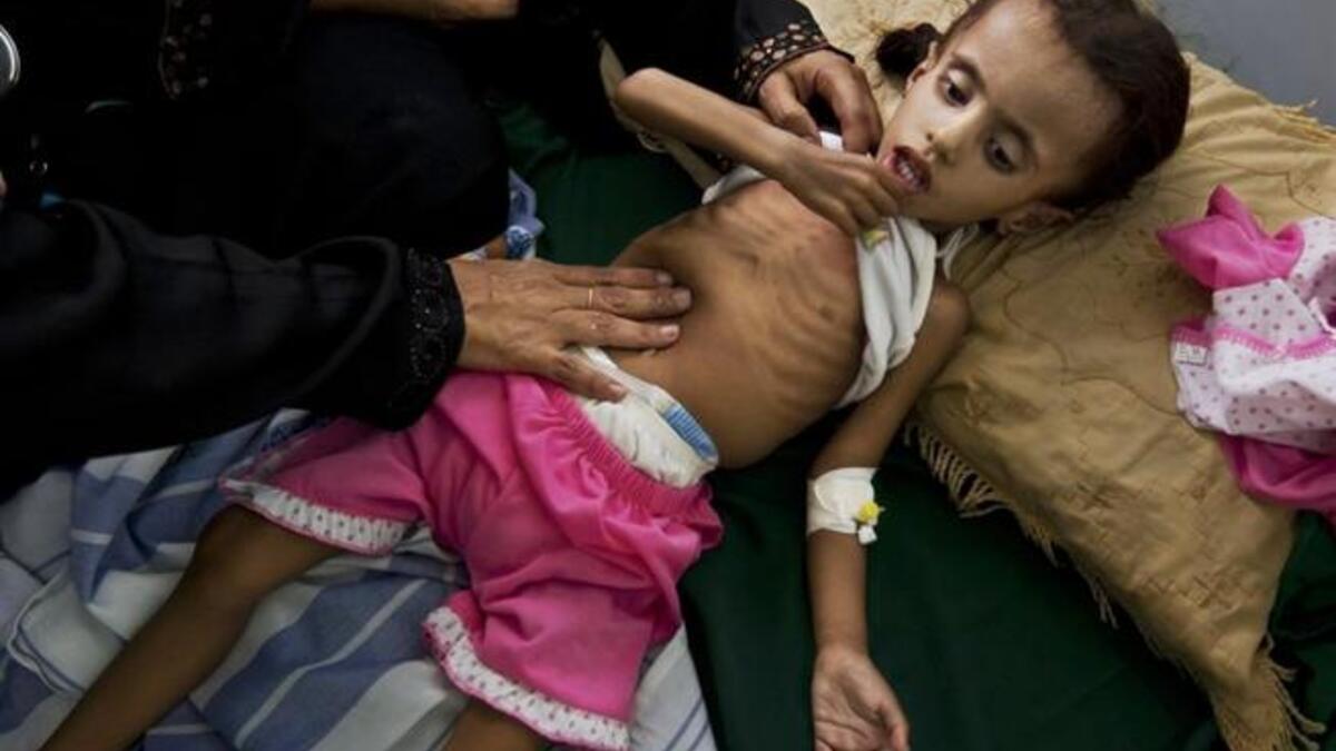 Yemen issues: Starving child in Yemen