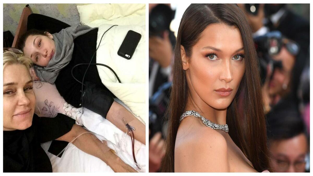 عارضة الأزياء بيلا حديد: في عام 2012 تم تشخيصها بمرض (لايم) مع والدتها يولاندا حديد، وشقيقها الأصغر أنور حديد، وهو مرض خمجي ينتج عن الإصابة بواحد من إحدى 3 أنواع من بكتيريا البوريليا ويتسبب بطفح جلدي.