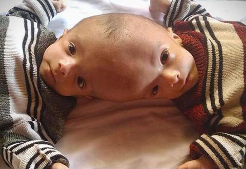 Yemeni Conjoined Twins Will Finally be Separated!