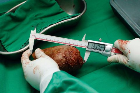 Doctors remove 