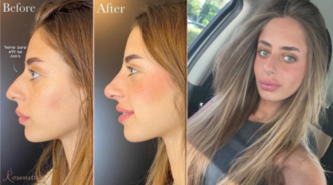 الأسيرة الإسرايلية ميا شيم تخضع لعملية تجميل.. شاهدوا شكلها