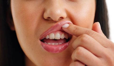 أسباب التهاب اللثة المستمر