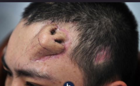 حصرياً..ابتكار جراحي مذهل لإعادة بناء أنف مدمّر