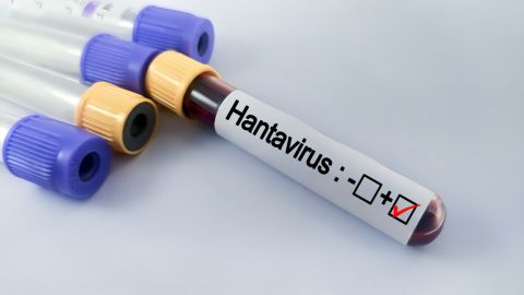 Flight attendant hospitalized with Hantavirus symptoms in Netherlands